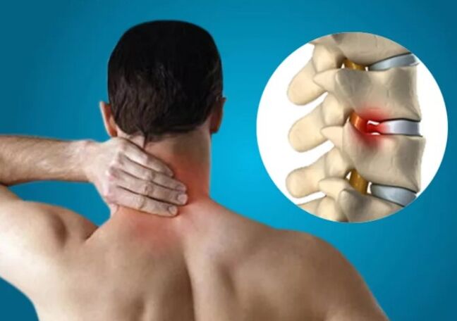 Cervikálna osteochondróza