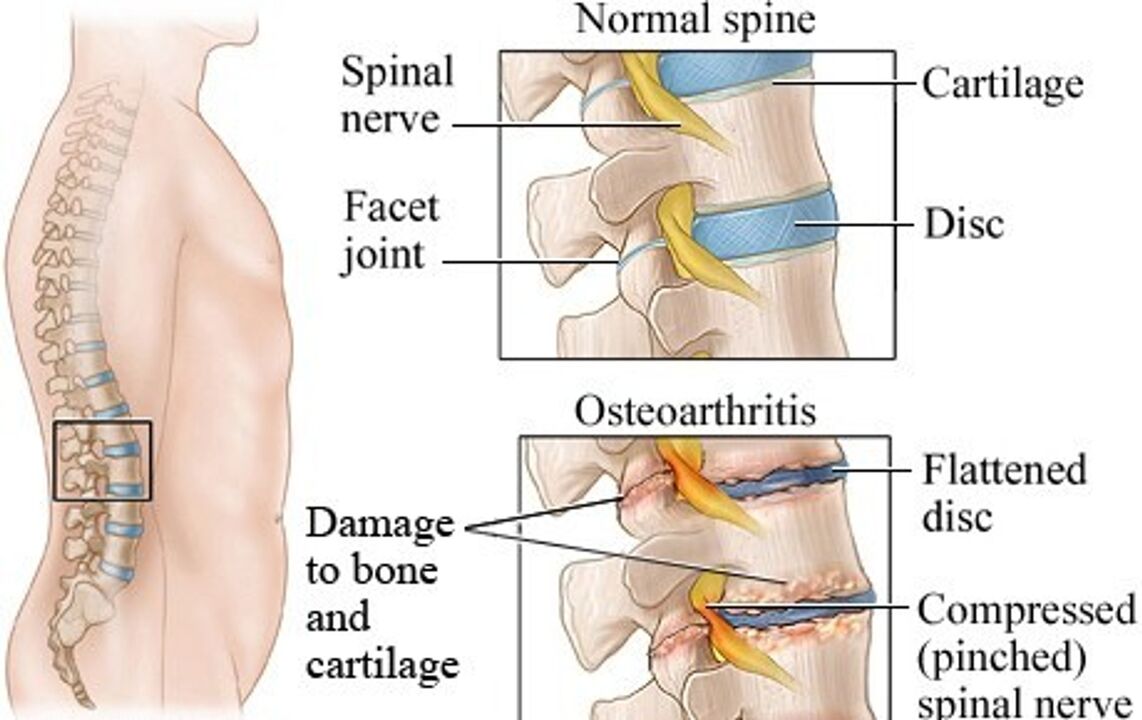 Rozdiel medzi zdravým diskom a diskom s osteochondrózou