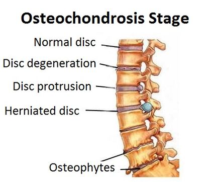 Štádiá osteochondrózy